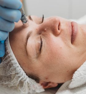cit-needling
