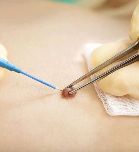 diathermy